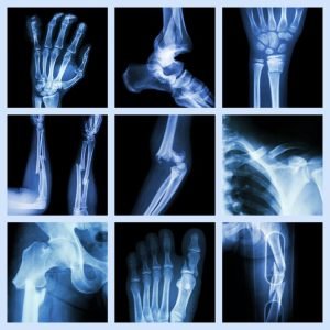 x-ray bones