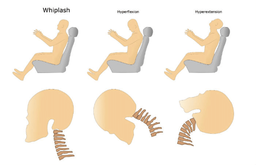 whiplash, hyperflexion, hyperextension